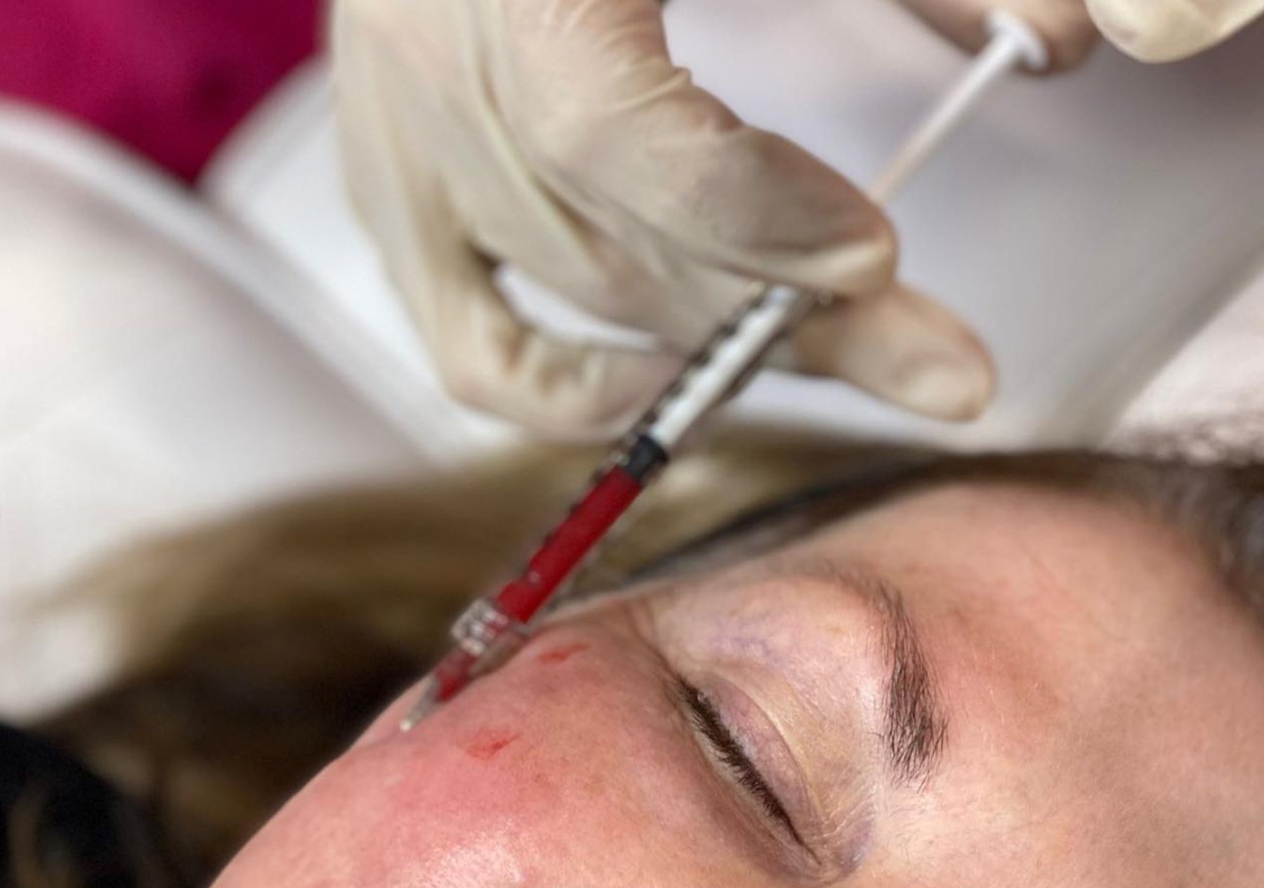 Botox Cairns